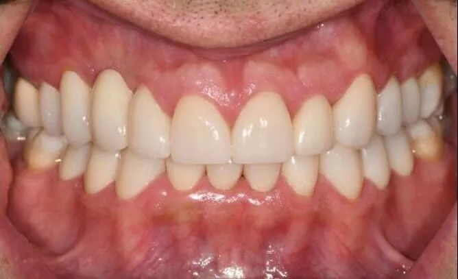 The same smile after prosthodontic treatment, with even, natural-looking restorations