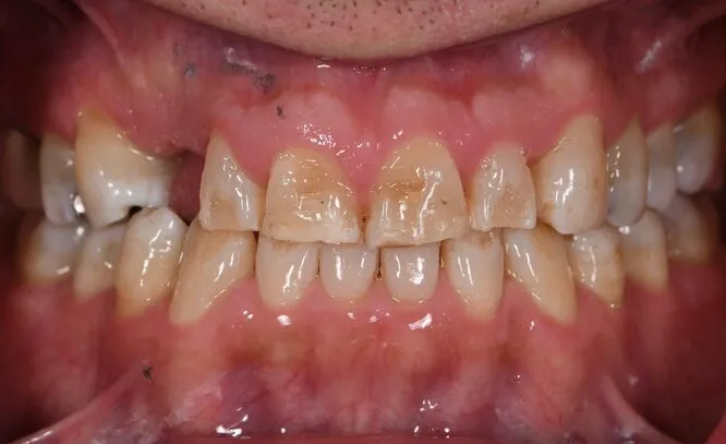 Close-up of a patient’s smile before treatment, showing worn and discoloured upper front teeth
