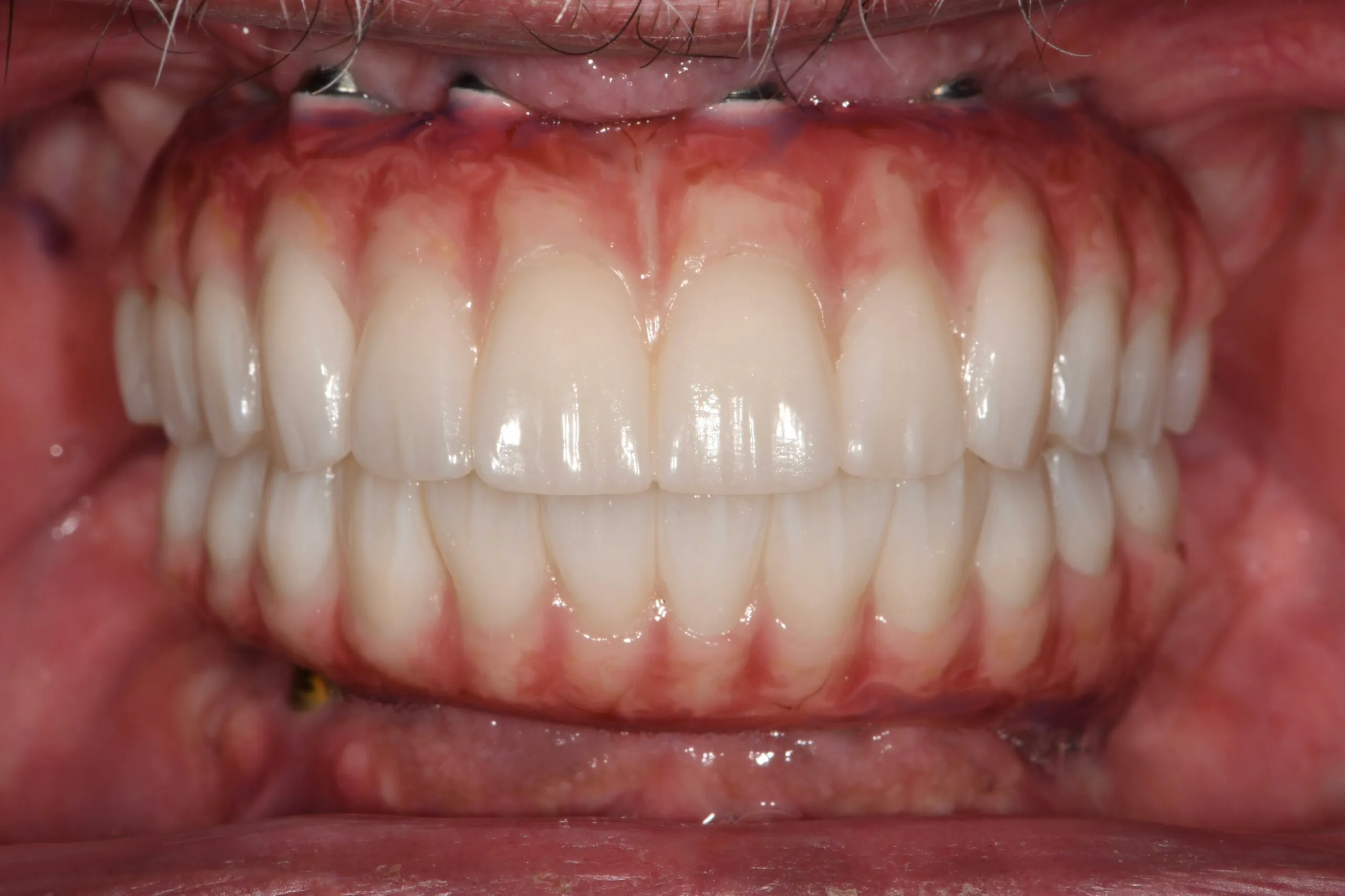 The same smile after full-arch rehabilitation, with a complete, uniform set of teeth