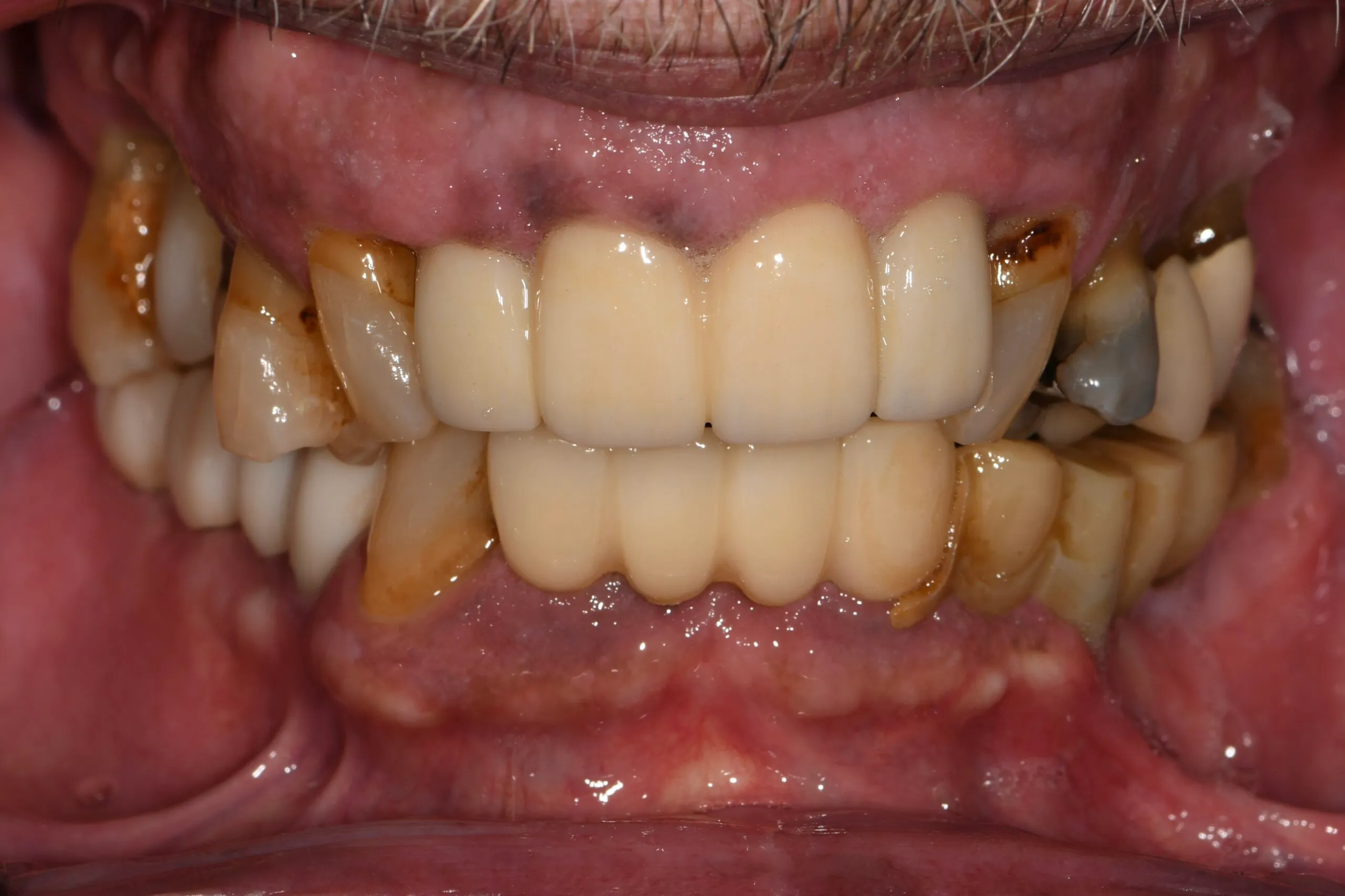 Close-up of a patient’s smile before treatment, showing heavy staining and worn lower teeth