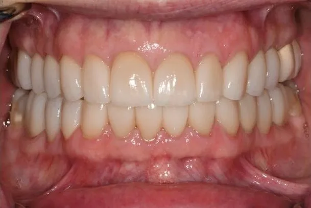 The same smile after restorative treatment, with brighter, evenly aligned teeth