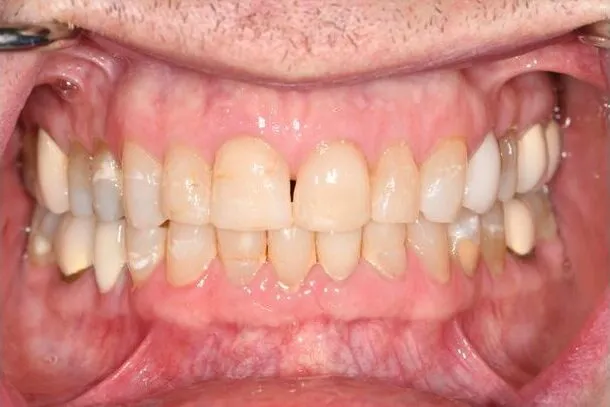 Close-up of a patient’s smile before treatment, showing yellowed and uneven teeth